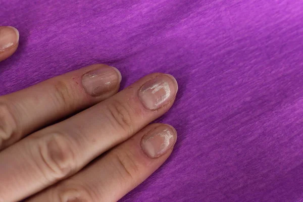 Well Groomed Sloppy Nails Need Manicure Pedicure Macro Photo — Stock Photo, Image