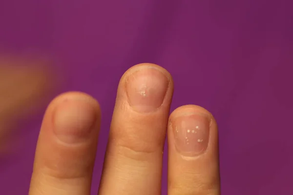 Well Groomed Sloppy Nails Need Manicure Pedicure Macro Photo — Stock Photo, Image