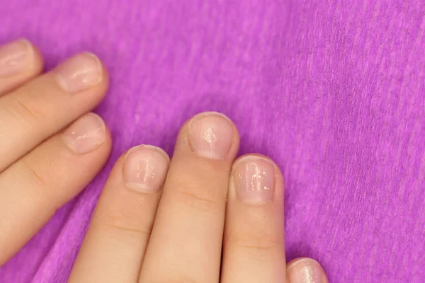 Las Uñas Descuidadas Bien Arregladas Necesitan Manicura Pedicura Macro Foto —  Fotos de Stock