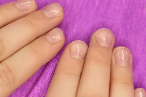 Las Uñas Descuidadas Bien Arregladas Necesitan Manicura Pedicura Macro Foto —  Fotos de Stock