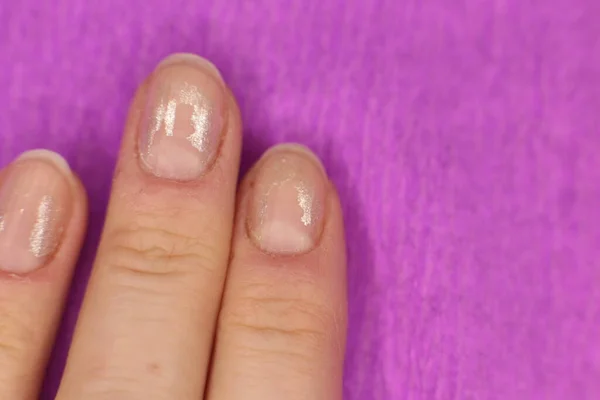 Nie Zadbane Niechlujne Paznokcie Potrzebują Manicure Pedicure Makro Zdjęcie — Zdjęcie stockowe