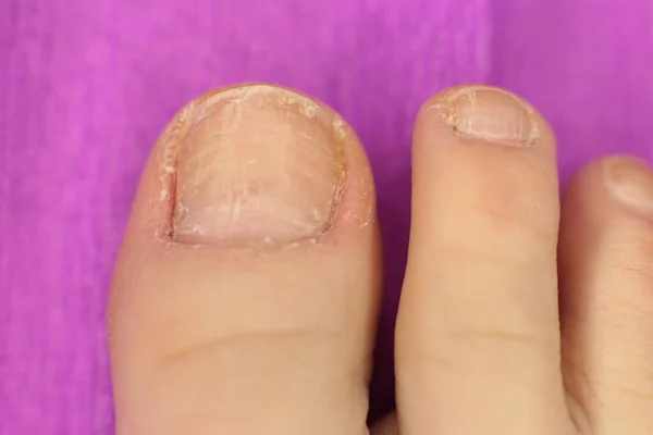 Niet Goed Verzorgde Slordige Nagels Nodig Manicure Pedicure Macro Foto — Stockfoto