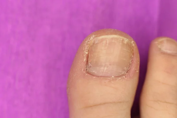 Niet Goed Verzorgde Slordige Nagels Nodig Manicure Pedicure Macro Foto — Stockfoto