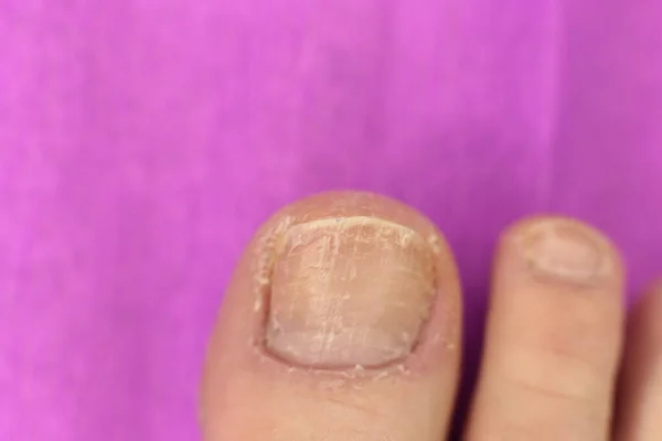 Niet Goed Verzorgde Slordige Nagels Nodig Manicure Pedicure Macro Foto — Stockfoto