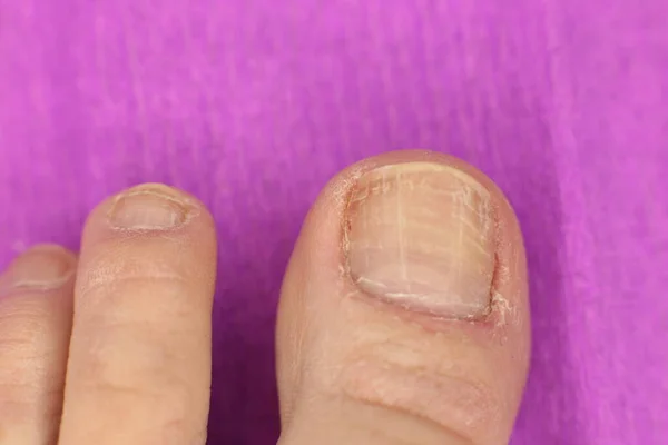 Niet Goed Verzorgde Slordige Nagels Nodig Manicure Pedicure Macro Foto — Stockfoto