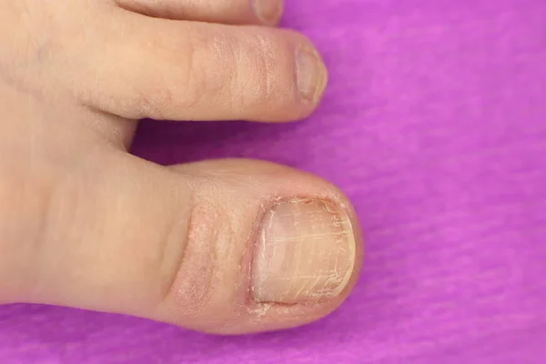 Well Groomed Sloppy Nails Need Manicure Pedicure Macro Photo — Stock Photo, Image