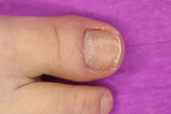 Niet Goed Verzorgde Slordige Nagels Nodig Manicure Pedicure Macro Foto — Stockfoto