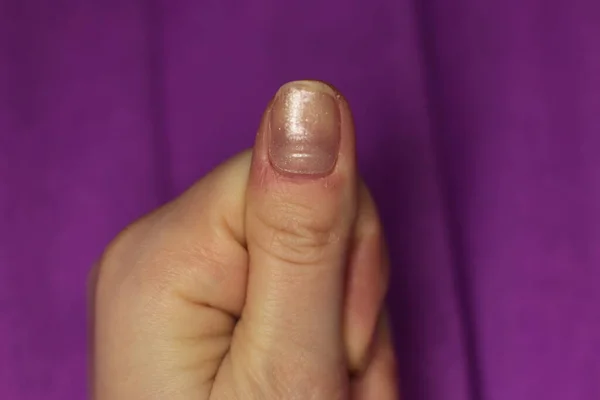 Las Uñas Descuidadas Bien Arregladas Necesitan Manicura Pedicura Macro Foto —  Fotos de Stock