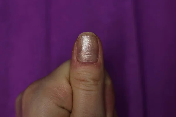 Well Groomed Sloppy Nails Need Manicure Pedicure Macro Photo — Stock Photo, Image