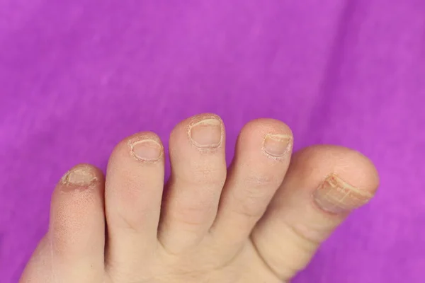 Niet Goed Verzorgde Slordige Nagels Nodig Manicure Pedicure Macro Foto — Stockfoto