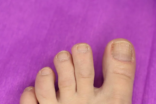 Well Groomed Sloppy Nails Need Manicure Pedicure Macro Photo — Stock Photo, Image