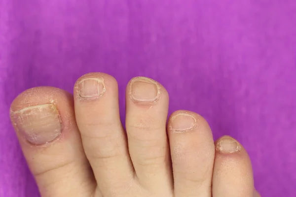 Well Groomed Sloppy Nails Need Manicure Pedicure Macro Photo — Stock Photo, Image