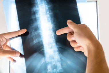 Doktor insan omurgasının röntgen filmini inceliyor.