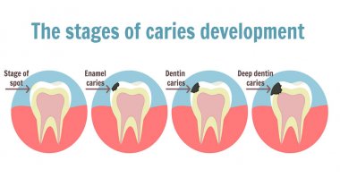 The stages of caries development. Dental toothache symbol clipart