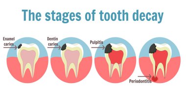 Diş çürüğü Infographic aşamaları. Diş diş ağrısı sembolü