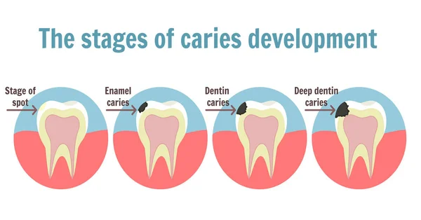 Le fasi di sviluppo della carie. Simbolo del mal di denti — Vettoriale Stock