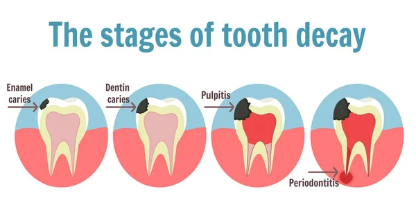 Le fasi di carie infografica. Simbolo del mal di denti — Vettoriale Stock