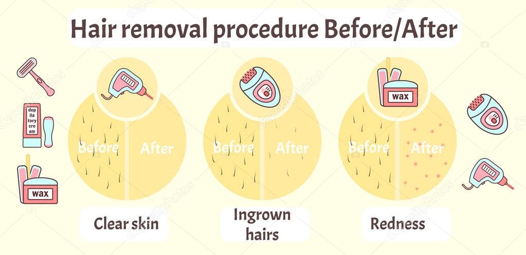 Flat vector hair removal aftereffects infographics