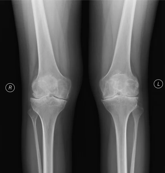 Real skeleton x-ray of woman knee suffering from rheumatism. Rheumatoid arthritis knee pain medical concept, medical diagnostics, traumatology and orthopedics