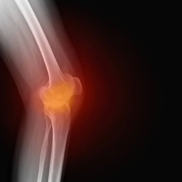 Igazi Csontváz Röntgen Egy Reumában Szenvedő Térdéről Rheumatoid Arthritis Térd — Stock Fotó
