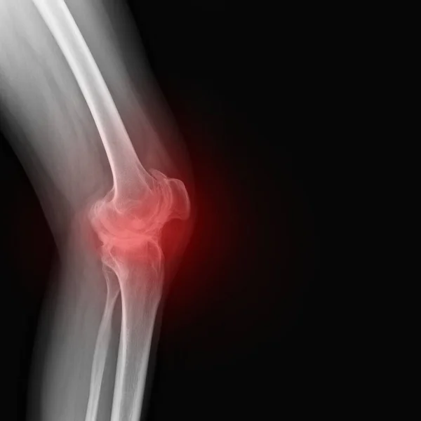 Echtes Skelett Röntgenbild Des Rheuma Leidenden Knies Einer Frau Rheumatoide — Stockfoto