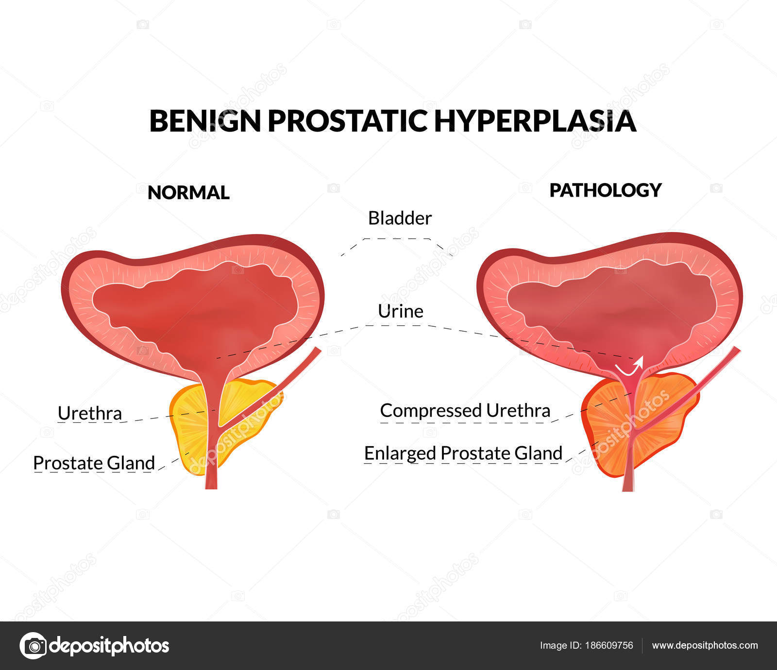 Papillomavírus chlamydia prostatitis