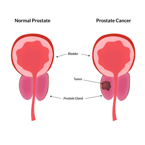 Tumor pada kelenjar prostat - Stok Vektor