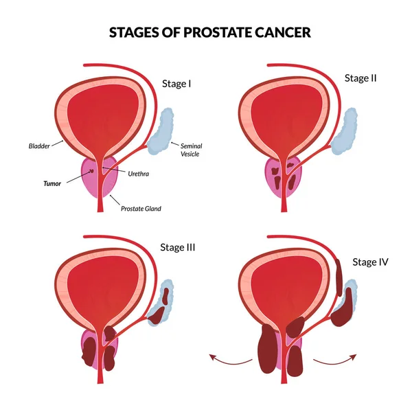 Cuatro etapas del cáncer de próstata — Vector de stock