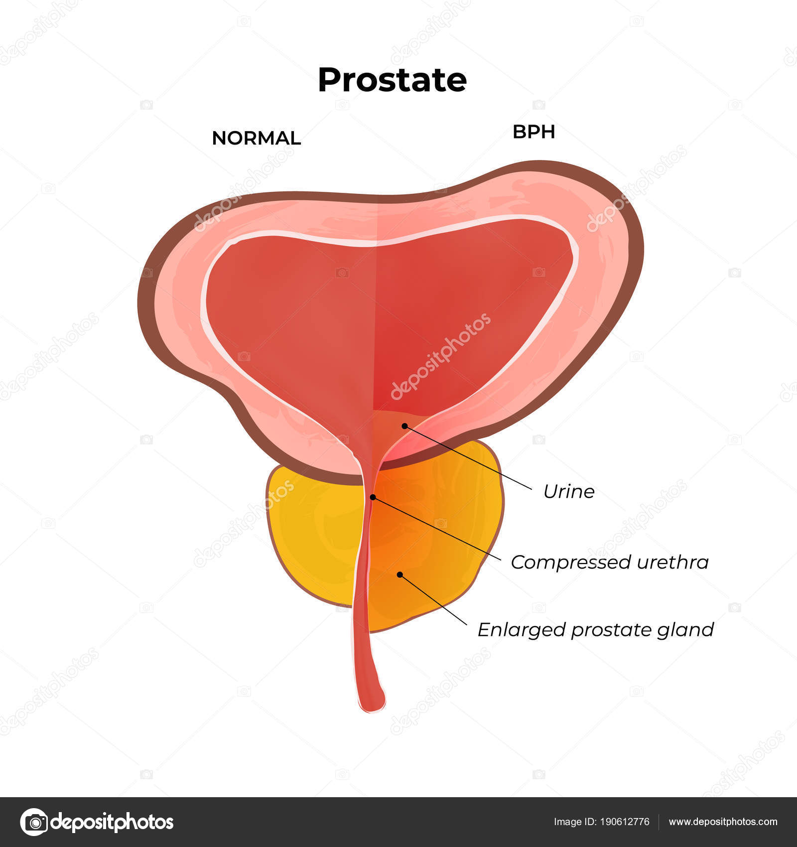 Prostatitis a hátsó miatt)