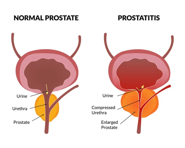 Affiche Prostatite pathologie — Image vectorielle