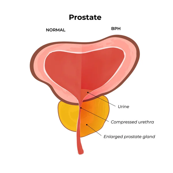 Próstata normal e inflamada — Vetor de Stock