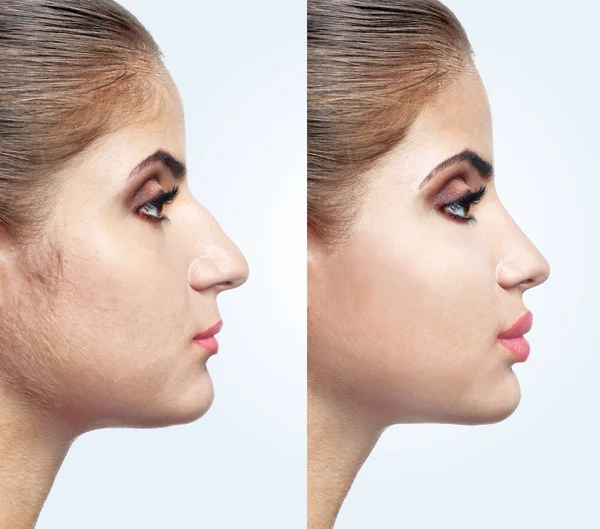 Woman face before and after cosmetic procedure, Plastic surgery concept