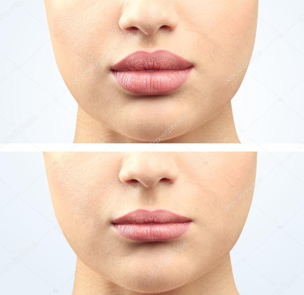 Lábio Mulher Antes Depois Procedimento Cosmético Conceito Cirurgia