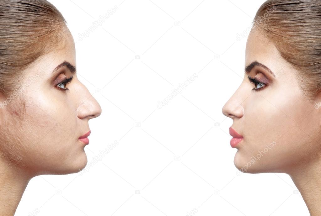 Woman face before and after cosmetic procedure, Plastic surgery concept 