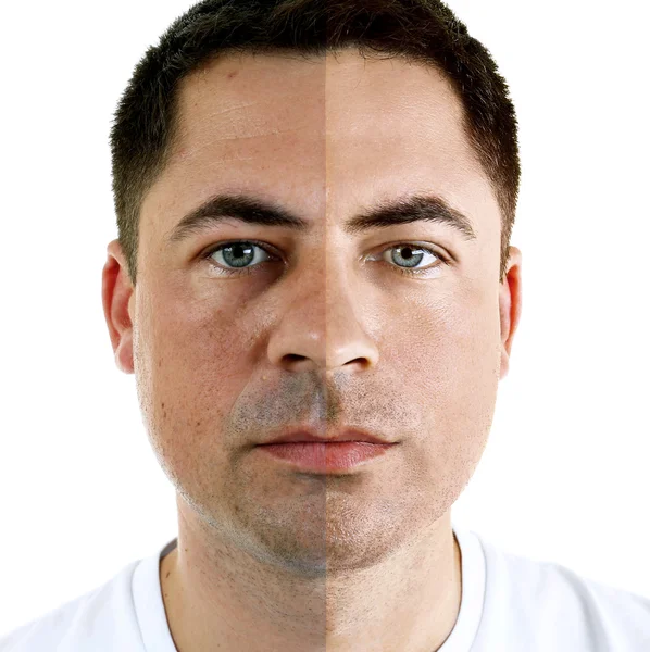 Человек лицом до и после косметической процедуры. Концепция пластической хирургии . — стоковое фото