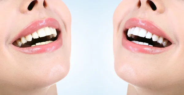 Ukázka výsledku bělení zubů před a po zákroku. Koncept stomatologie. — Stock fotografie