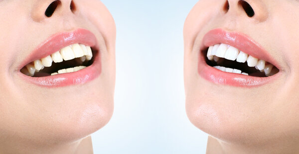 Demonstration of dental whitening result, before and after procedure. Dentistry concept.