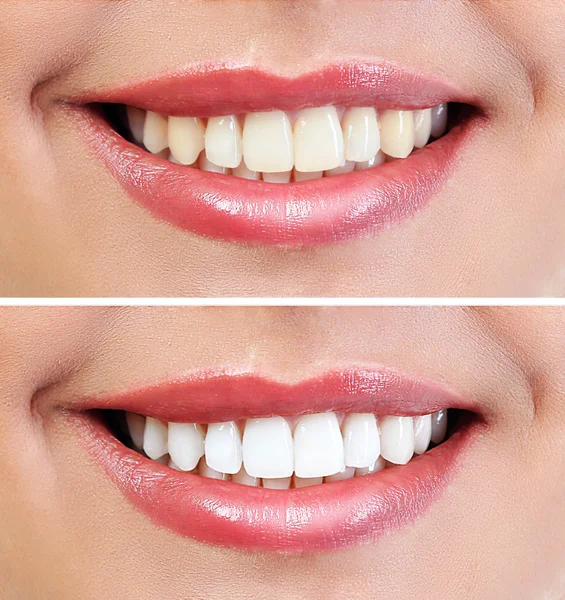 Demostración del resultado del blanqueamiento dental, antes y después del procedimiento. Concepto odontológico . — Foto de Stock