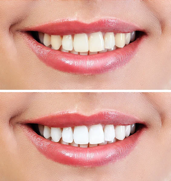 Gösteri diş beyazlatma sonuç, önce ve sonra yordamı. Diş Hekimliği kavramı. Telifsiz Stok Imajlar