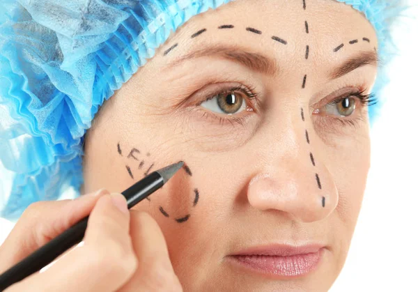 Surgeon hand drawing marks on female face for plastic operation — Stock Photo, Image