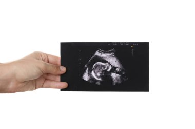 Ultrasound picture of baby clipart