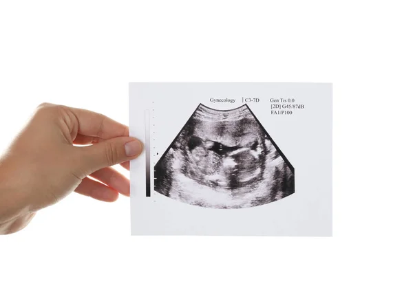 Echografie foto van de baby — Stockfoto