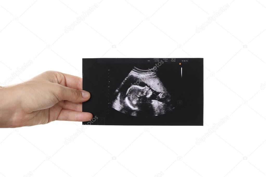 Ultrasound picture of baby