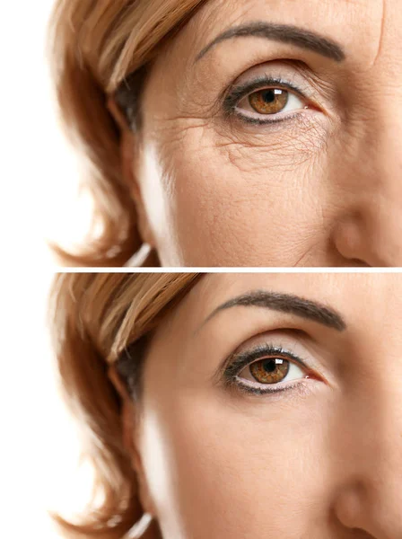 Gesicht vor und nach kosmetischen Eingriffen — Stockfoto
