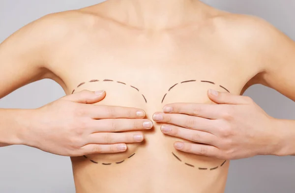 Breasts marked for plastic operation — Stock Photo, Image