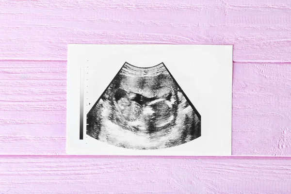 Ecografia baby scan — Foto Stock