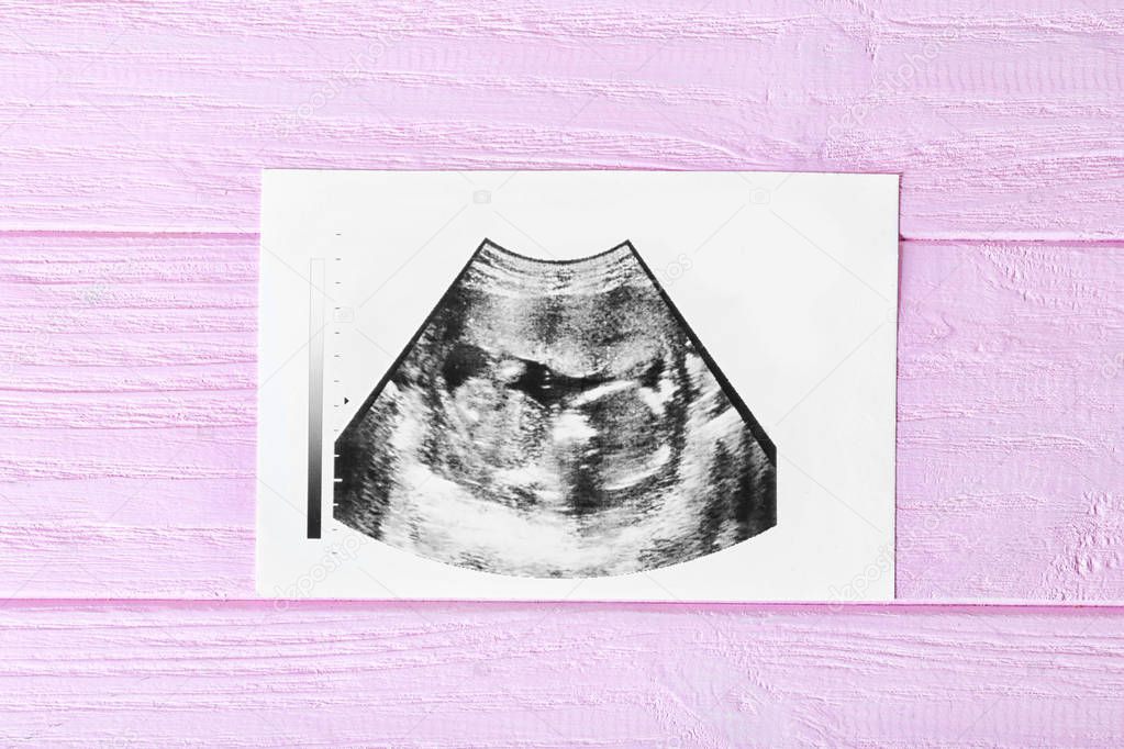Ultrasound baby scan