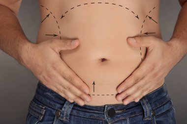Genç erkek vücudu işaretleri plastik işlemi, gri arka plan için. Liposuction kavramı