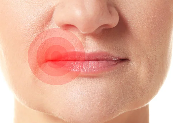 Женские губы с вирусом герпеса, крупный план — стоковое фото
