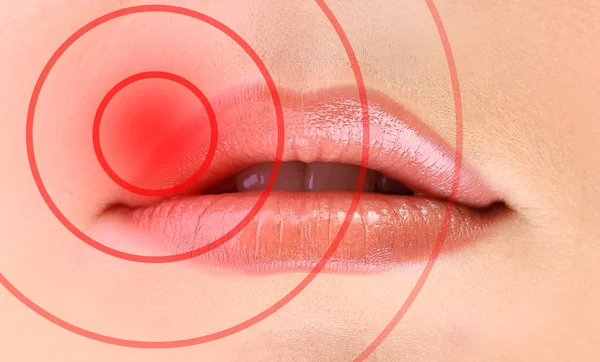 Vrouwelijke lippen met herpesvirus, close-up — Stockfoto